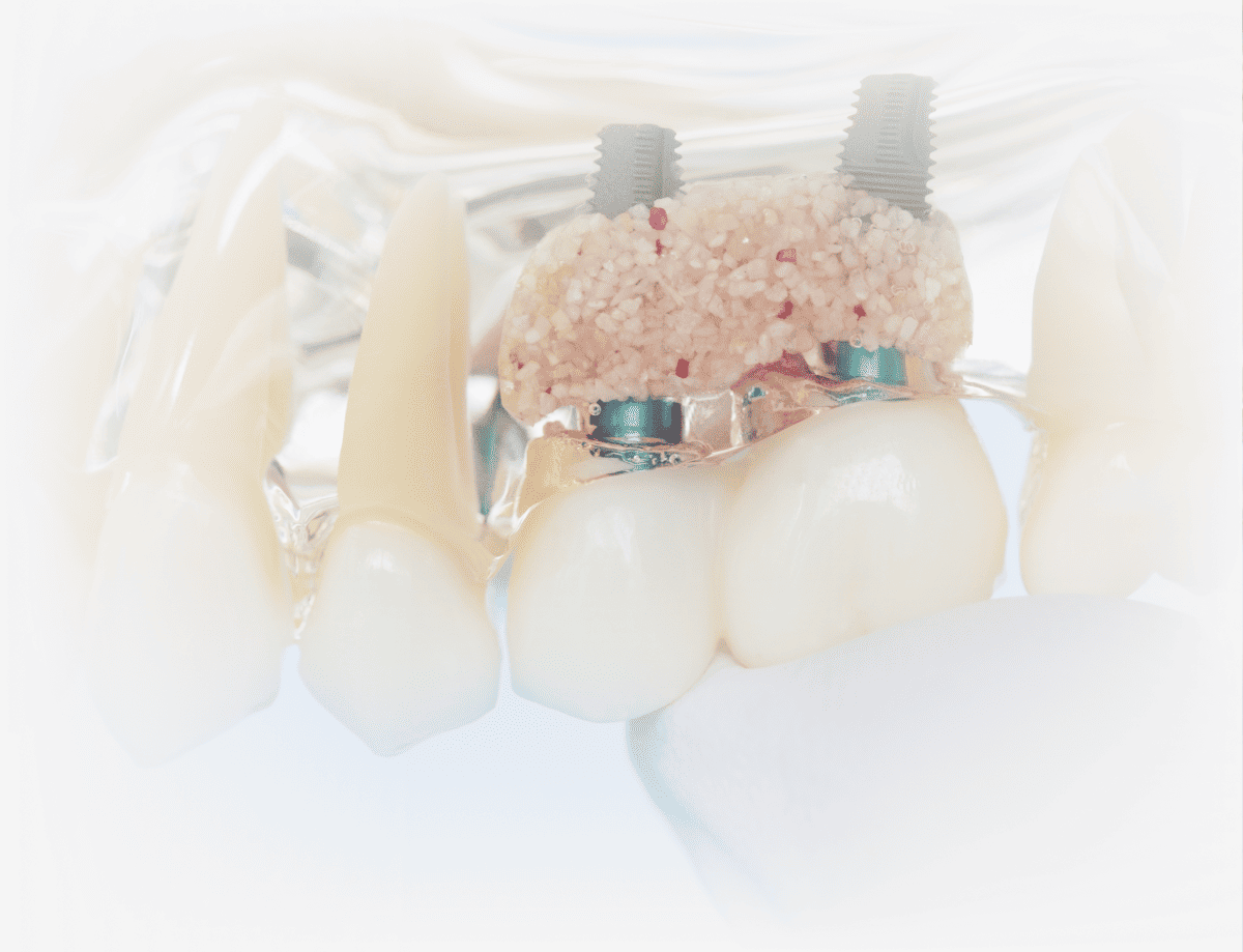 Імплантація зубів системою Dentium Superline