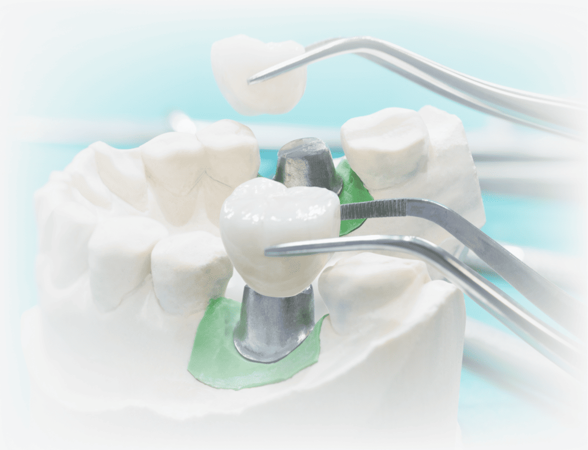 Коронка керамічна на імпланті у Києві