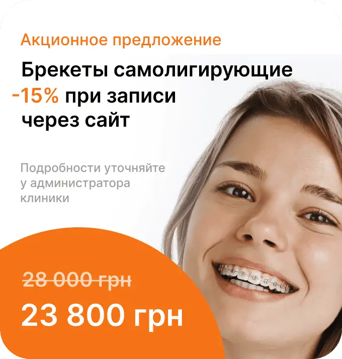 Банер самолігуючі брекети